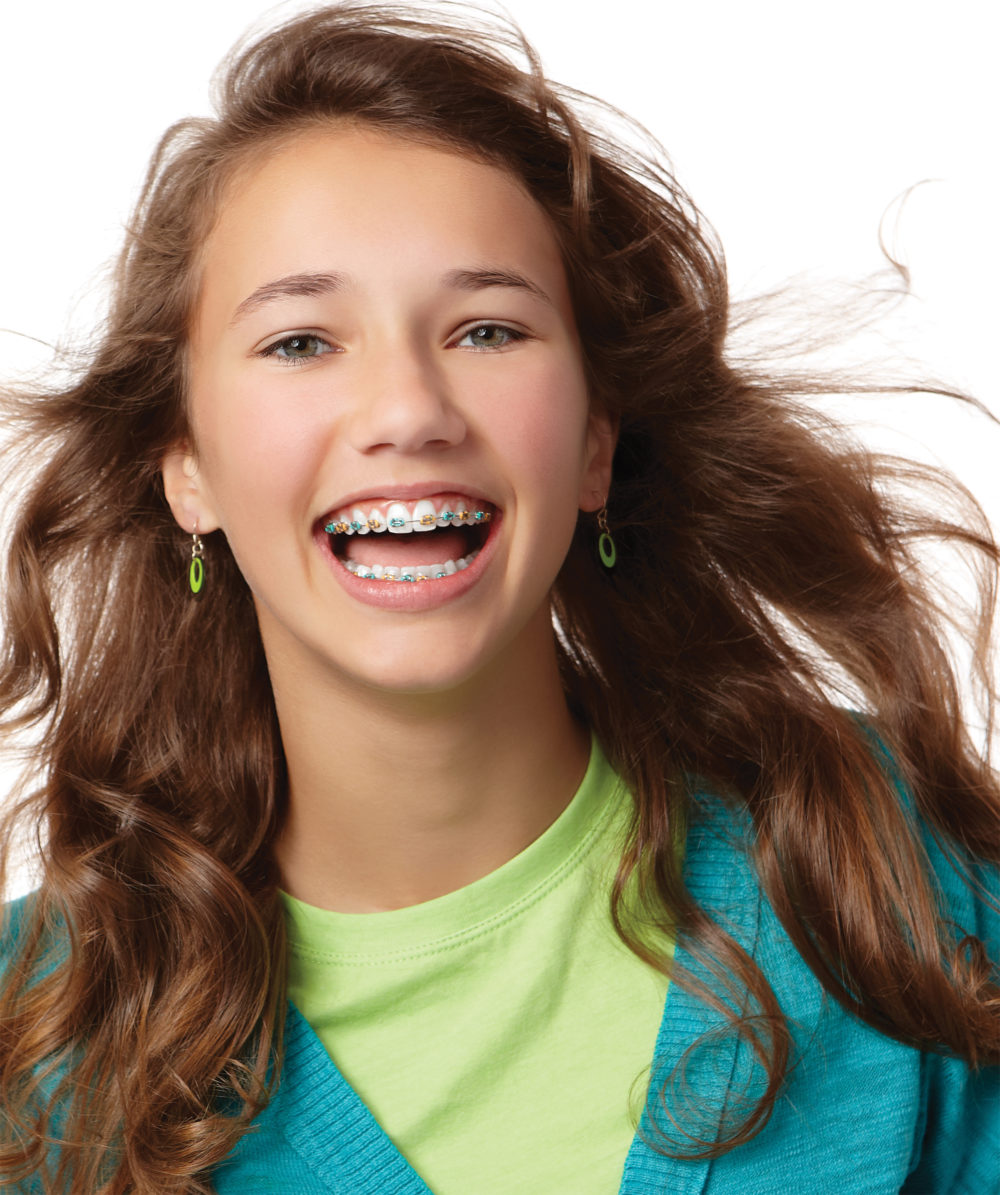 Types of Braces - Braces with colors (Traditional and Self-Ligating) Metal braces...