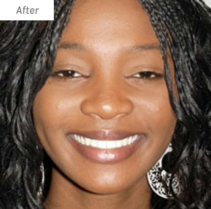 Woman smiling at camera displaying results of orthodontic dental treatment.