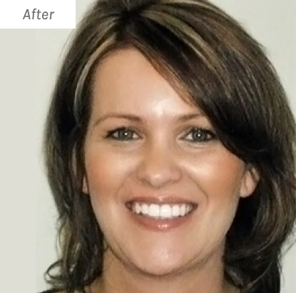 Woman smiling at camera after orthodontic treatment, professional headshot portrait
