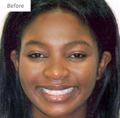 Woman smiling at camera in before orthodontic treatment portrait photo.