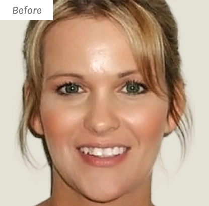 Woman smiling at camera, labeled "Before" orthodontic treatment photo