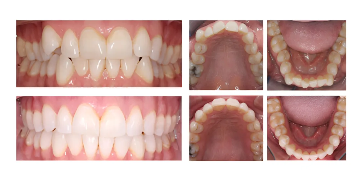 Before and after orthodontic treatment showing dental alignment and bite correction from multiple angles.