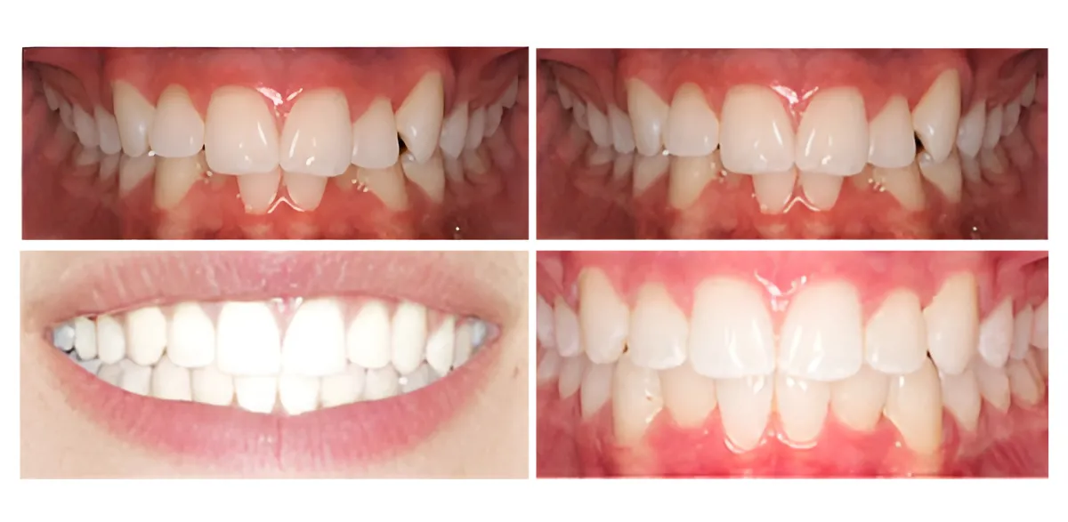 Before and after orthodontic treatment showing dental alignment improvements and smile transformation.