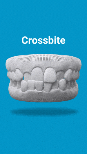 3D dental model showing crossbite malocclusion on blue background for orthodontic education.