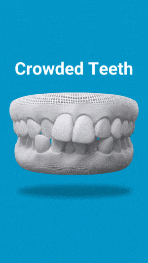 3D dental model showing crowded teeth condition on blue background with text label.