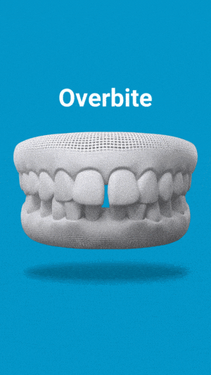 Dental model showing overbite malocclusion with upper teeth extending over lower teeth on blue background.