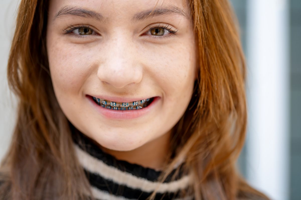 carriere-motion-appliances-for-overbite-orthodontist-broken-arrow-ok