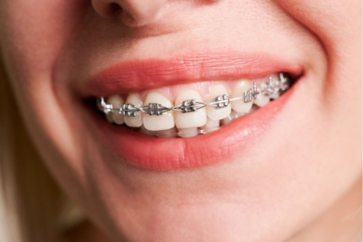 how-braces-fix-crossbite-broken-arrow-smiles