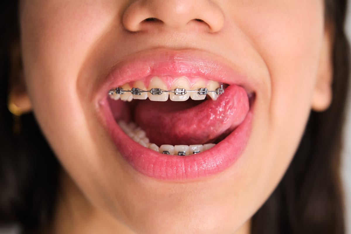 Braces in Broken Arrow